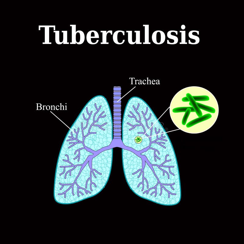 The Process of Tuberculosis Formation. Infographics. Vector