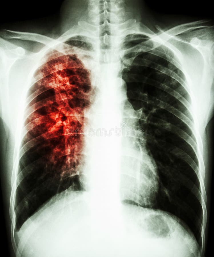 Tuberkulose Der Atmungsorgane Stockfoto - Bild von karosserie, krank