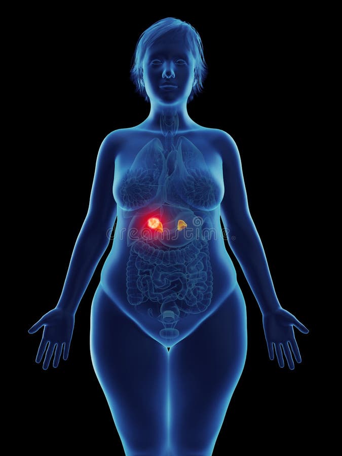 adrenal tumor on kidney adrenal tumor on kidney