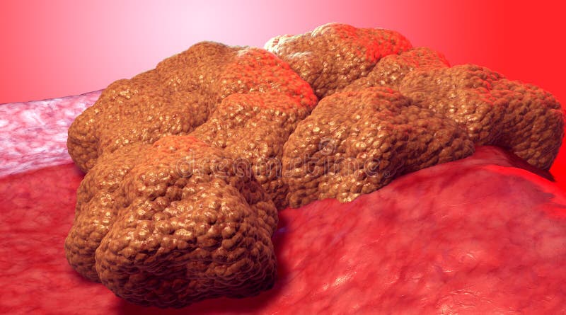 Tumore della cellula tumorale, illustrazione medica fotografie stock libere da diritti Tumore della cellula tumorale, illustrazione medica fotografie stock libere da diritti