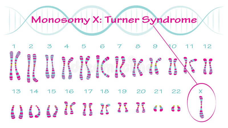 Monosomy X Turner Syndrome Karyotype Stock Vector Illustration Of