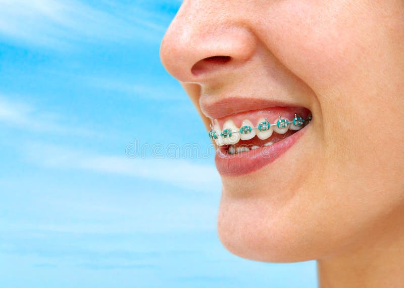 Dettaglio della giovane donna, il sorriso che mostra denti bianchi con le parentesi graffe.