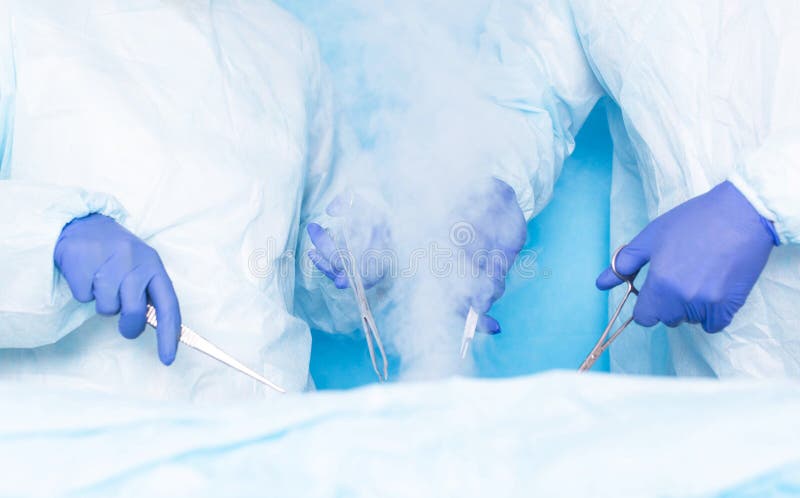 Twee chirurgen van Hiurge doen chirurgie gebruikend vloeibare cryotherapy stikstof om kwaadaardige tumors, tumors te verwijderen royalty-vrije stock afbeelding Twee chirurgen van Hiurge doen chirurgie gebruikend vloeibare cryotherapy stikstof om kwaadaardige tumors, tumors te verwijderen royalty-vrije stock afbeelding