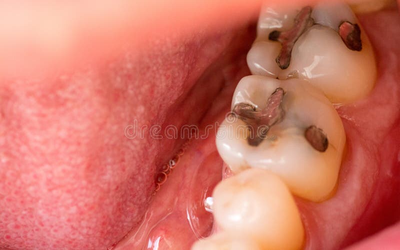 X ray of molars stock photo. Image of teeth, toothache 17769588
