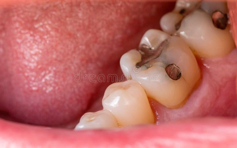 Filling Molars Photos Free Royalty Free Stock Photos From Dreamstime
