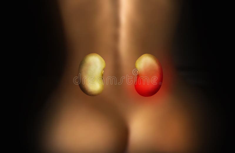 Two beans simulates human kidney inflammation with a blurry woman's silhouette in a background