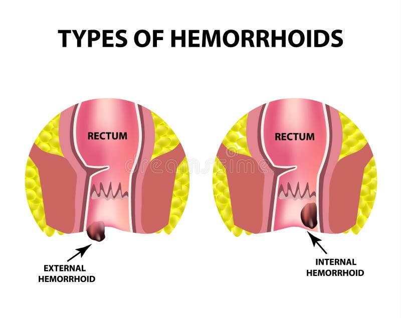 Hemorroides y gases intestinales