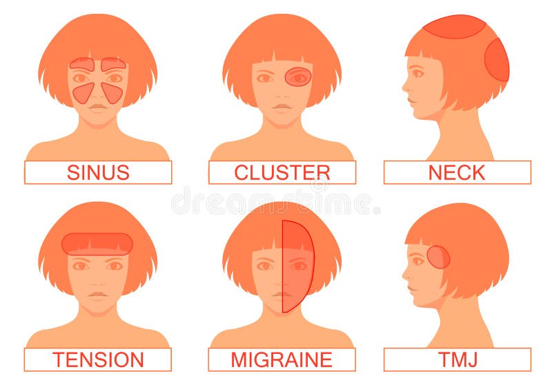 Type de douleur de mal de tête illustration de vecteur Type de douleur de mal de tête illustration de vecteur