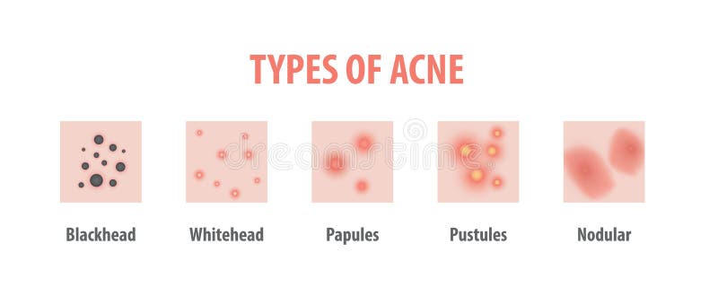 Types of Acne Diagram Illustration Vector on White Background, B Stock ...