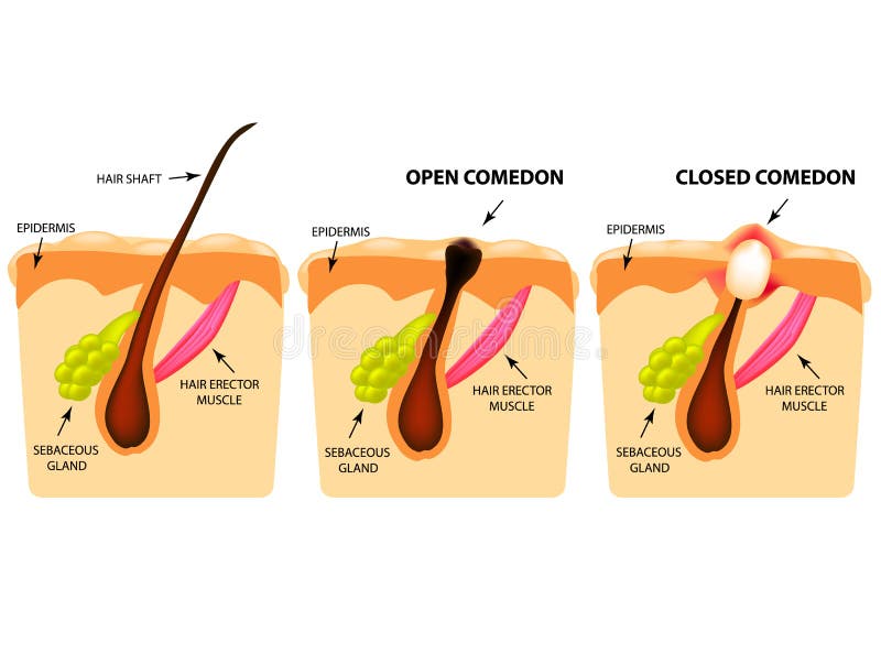 Types of acne. Open comedones, closed comedones, Skin structure. Infographics. Vector illustration on isolated background stock illustration Types of acne. Open comedones, closed comedones, Skin structure. Infographics. Vector illustration on isolated background stock illustration