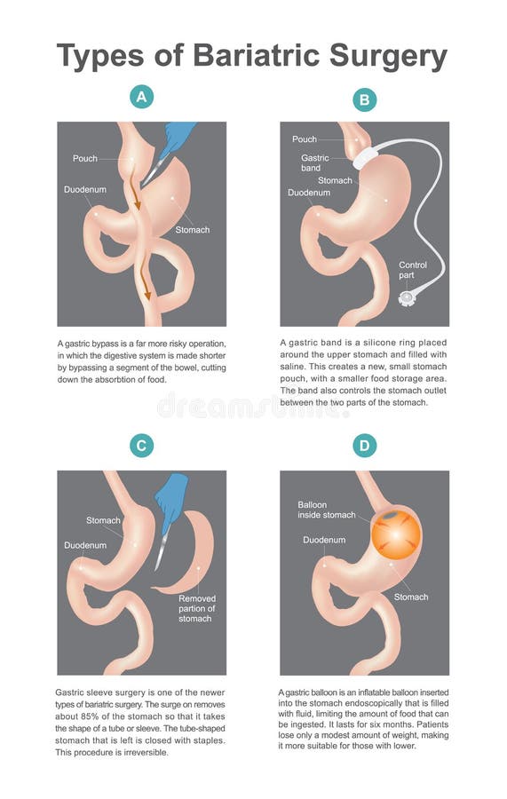 Бариатрия до и после операции Types of Bariatric Surgery, it is Process for the Digestive System in Stomach, .