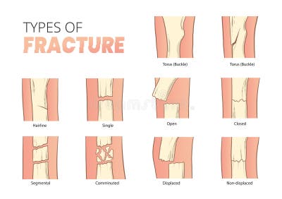 Types of Bones Fractures, Bones Fracture Classification Stock Vector