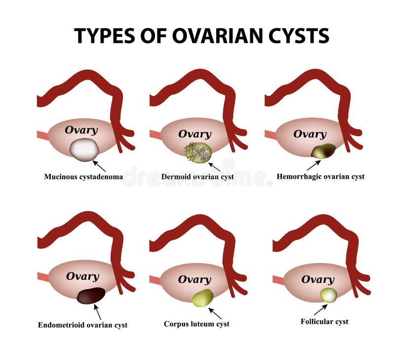Kyste Ovarien kyste-ovarien