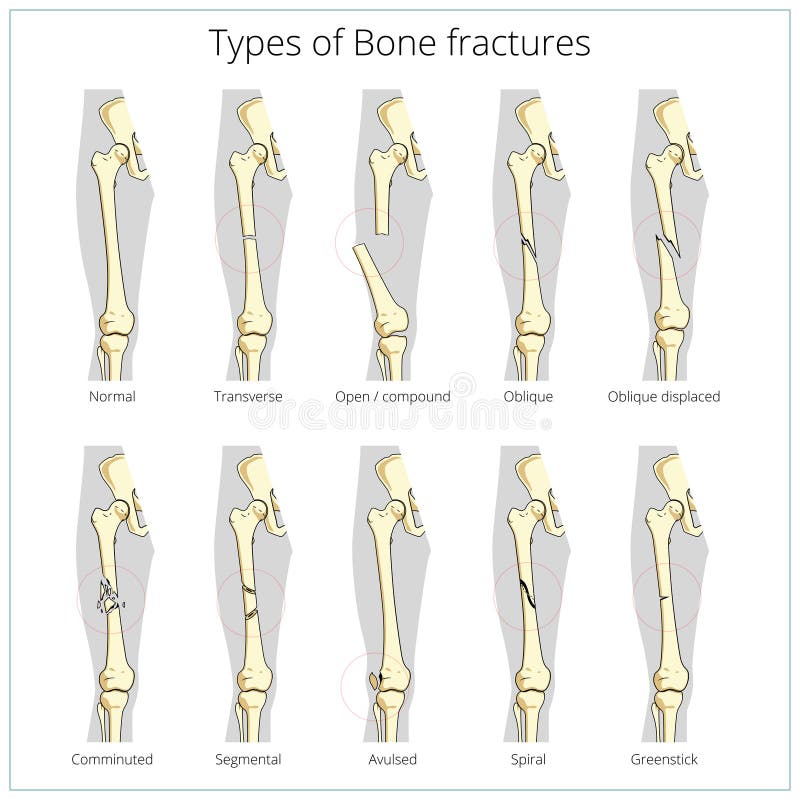 Types De Vecteur éducatif Médical De Fractures Illustration de Vecteur