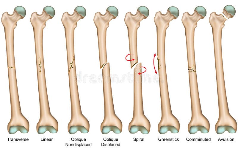 Types illustration médicale de fracture de vecteur illustration stock Types illustration médicale de fracture de vecteur illustration stock