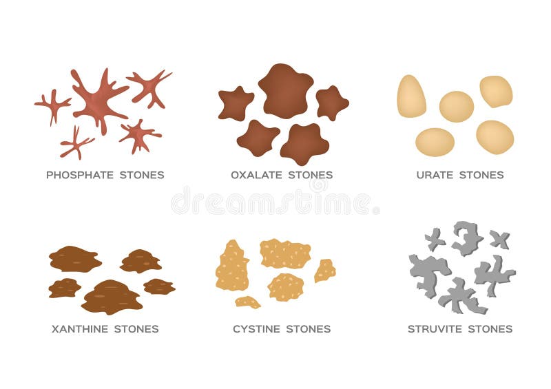 Kidney stone stock vector. Illustration of medicine, nephrology 88651075