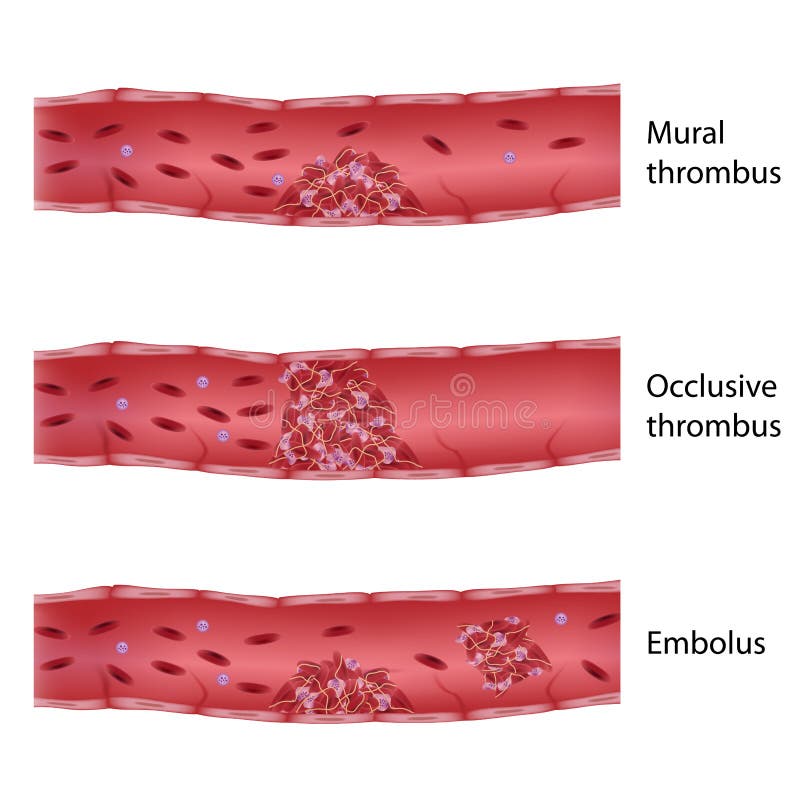 5 Types Of Thrombosis Thrombosis md Venzero