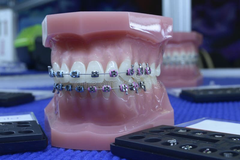 Typodont Plastic Moulage of Human Jaws Demonstrating Dental Braces on