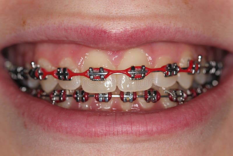 Tänder med metall stödjer ortodontikonsoler arkivbilder Tänder med metall stödjer ortodontikonsoler arkivbilder