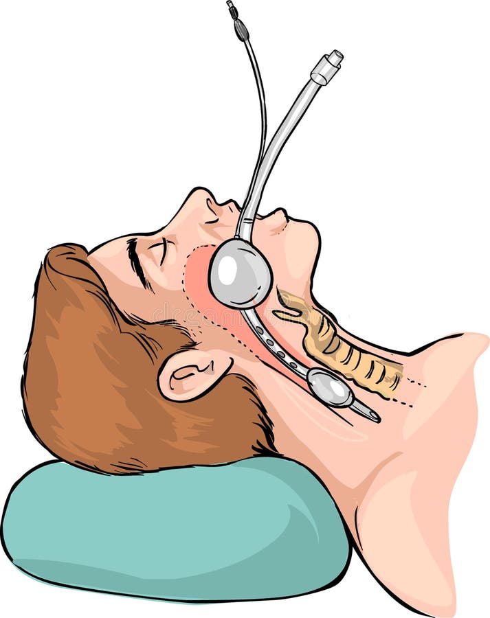 Vector color illustration of Technique of tubal intubation. Vector color illustration of Technique of tubal intubation