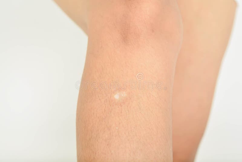 Scars Women's Legs Image & Photo (Free Trial)