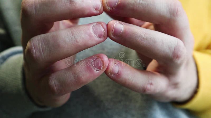 Woman Contracts Infection After Biting Nails | Independent Newspaper Nigeria