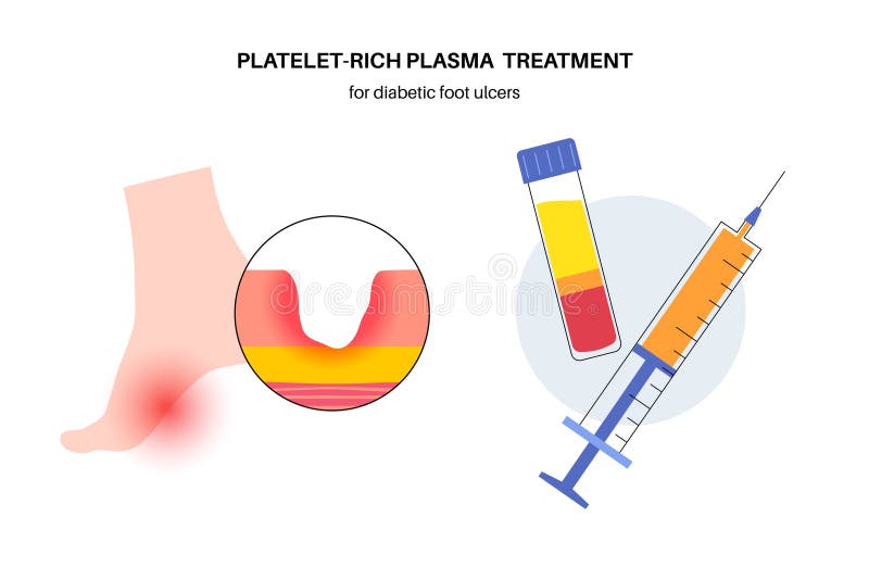 Le plasma riche en plaquettes (PRP) pour le traitement des ulcères du pied  diabétique 