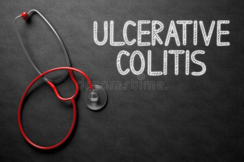 Medical Concept: Ulcerative Colitis on Black Chalkboard. Medical Concept: Ulcerative Colitis - Black Chalkboard with Hand Drawn Text and Red Stethoscope. Top View. 3D Rendering. Medical Concept: Ulcerative Colitis on Black Chalkboard. Medical Concept: Ulcerative Colitis - Black Chalkboard with Hand Drawn Text and Red Stethoscope. Top View. 3D Rendering.