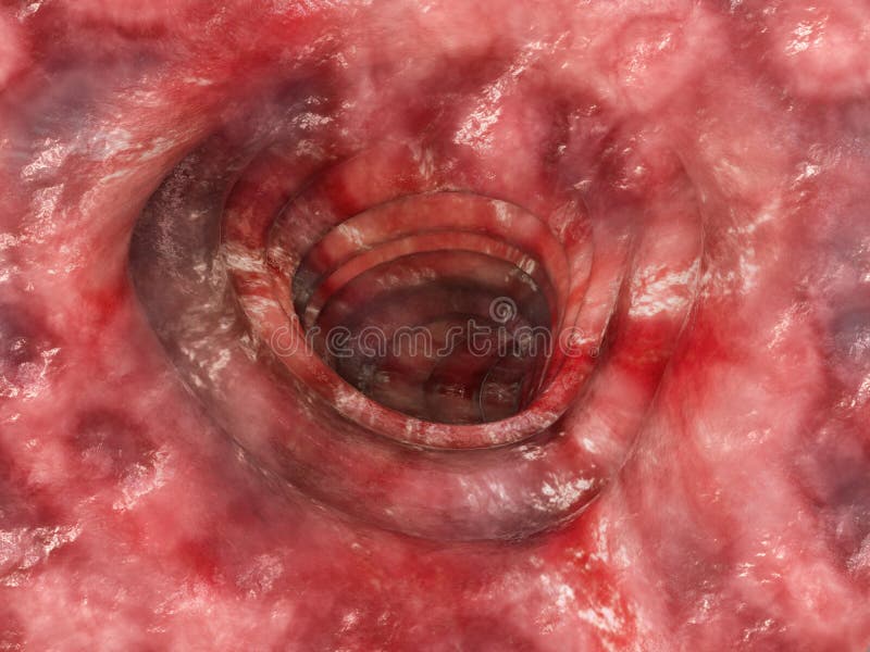 Ulcerosa de la colitis - etapa 4 - representación 3D stock de ilustración Ulcerosa de la colitis - etapa 4 - representación 3D stock de ilustración