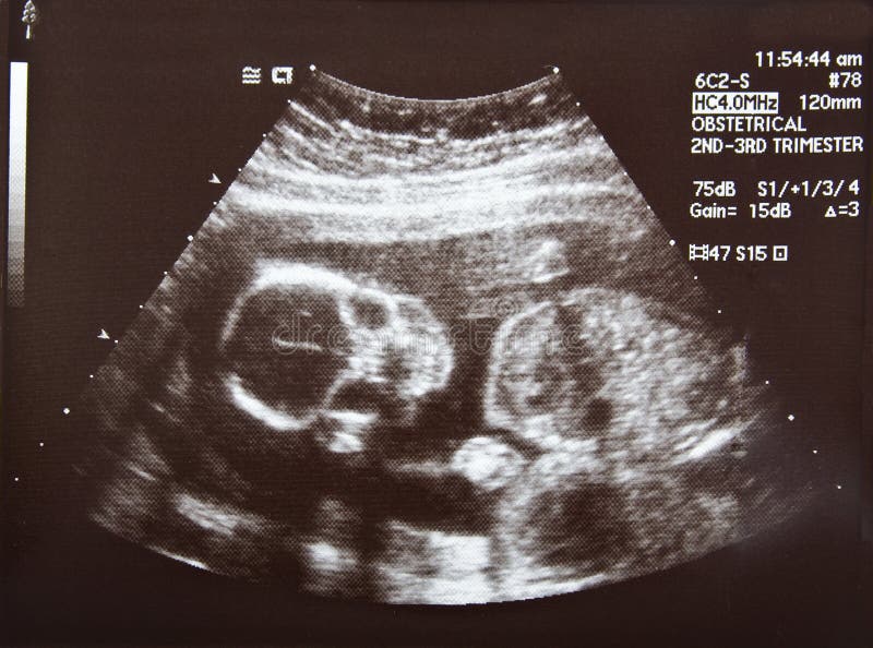 Ultrasone klank van een Schedel van het Foetus bij Vier Maanden royalty-vrije stock foto Ultrasone klank van een Schedel van het Foetus bij Vier Maanden royalty-vrije stock foto