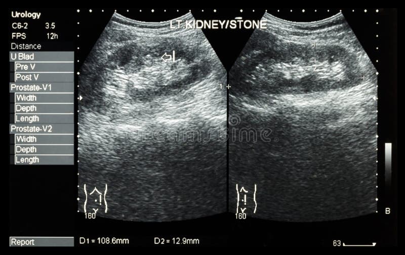 Ultrasonography of kidney : show left kidney stone ( 2 image for compare ) royalty free stock photography Ultrasonography of kidney : show left kidney stone ( 2 image for compare ) royalty free stock photography