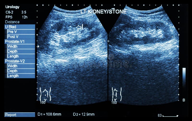Ultrasonography of kidney : show left kidney stone ( 2 image for compare ) royalty free stock photography Ultrasonography of kidney : show left kidney stone ( 2 image for compare ) royalty free stock photography