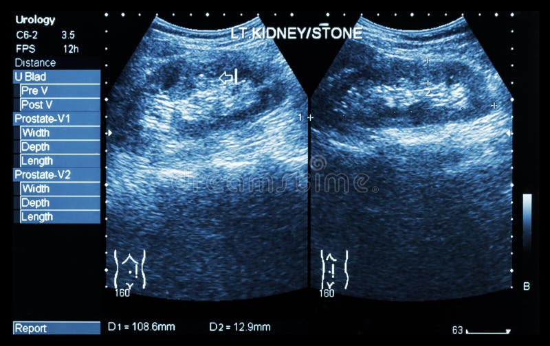 Ultrasonography of kidney : show left kidney stone ( 2 image for compare )