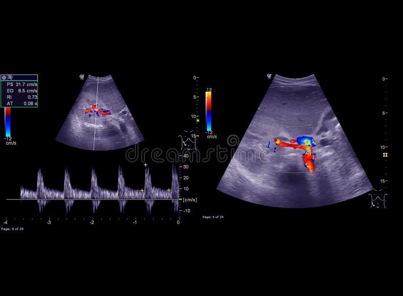 Ultrasonido superior barriga desplegado tasa de flujo en común bilis tubería después.