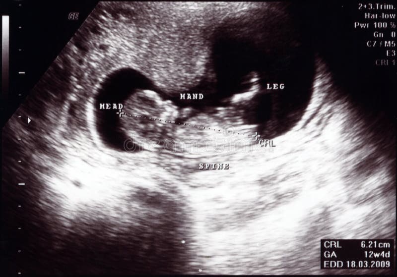 Ultrasound Scan 12 Weeks