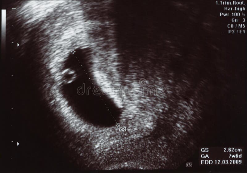 Pregnant Ultrasound