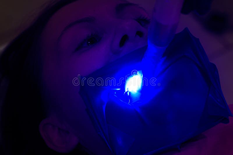 Ultraviolet Light in Dentistry, Treatment of Upper Masticatory Teeth