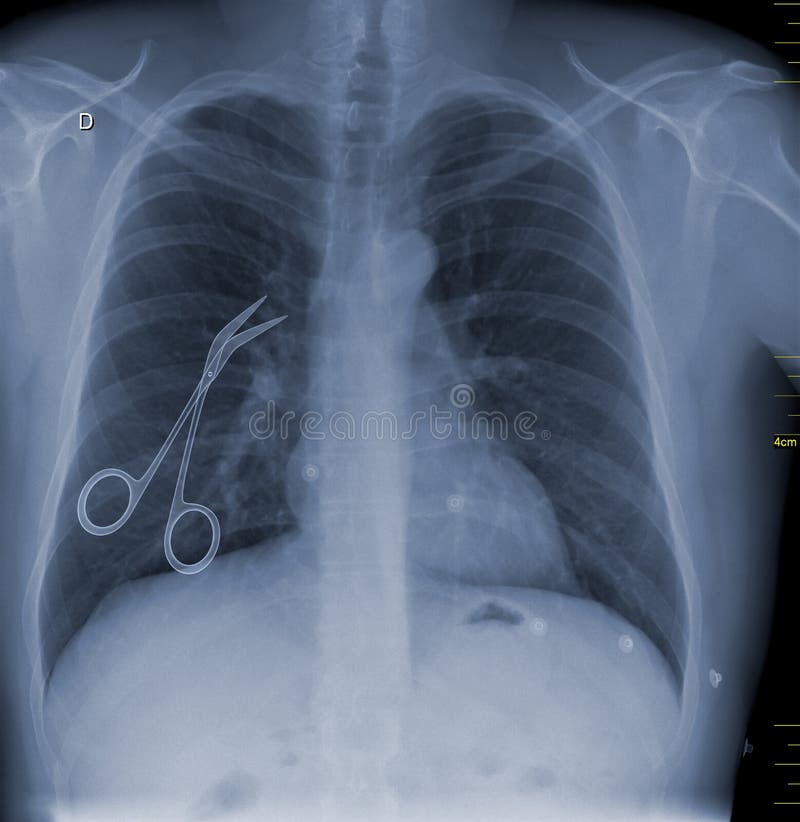 Uma imagem conceptual da negligência médica representada com as tesouras cirúrgicas deixadas dentro de um paciente após a cirurgi ilustração stock Uma imagem conceptual da negligência médica representada com as tesouras cirúrgicas deixadas dentro de um paciente após a cirurgi ilustração stock