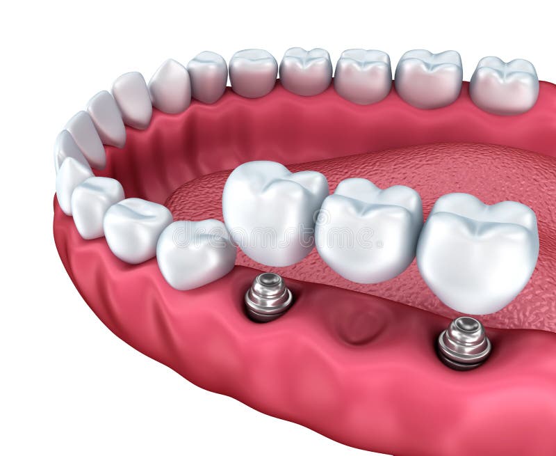 Uma opinião do close-up dos mais baixos dentes e de implantes dentais ilustração royalty free Uma opinião do close-up dos mais baixos dentes e de implantes dentais ilustração royalty free