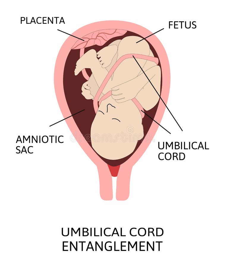 MRI showed a bulky protrusion of the amniotic sac into the abdominal... |  Download Scientific Diagram