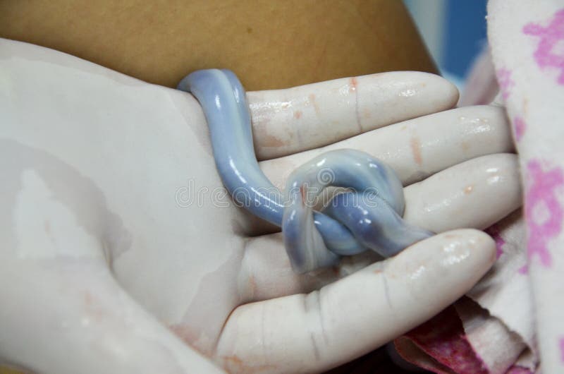 Umbilical cord of new born baby twisted into a knot. stock photos