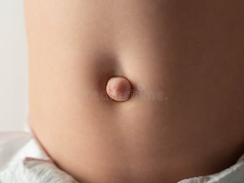 31 Umbilical Hernia Stock Photos, High-Res Pictures, and Images - Getty  Images