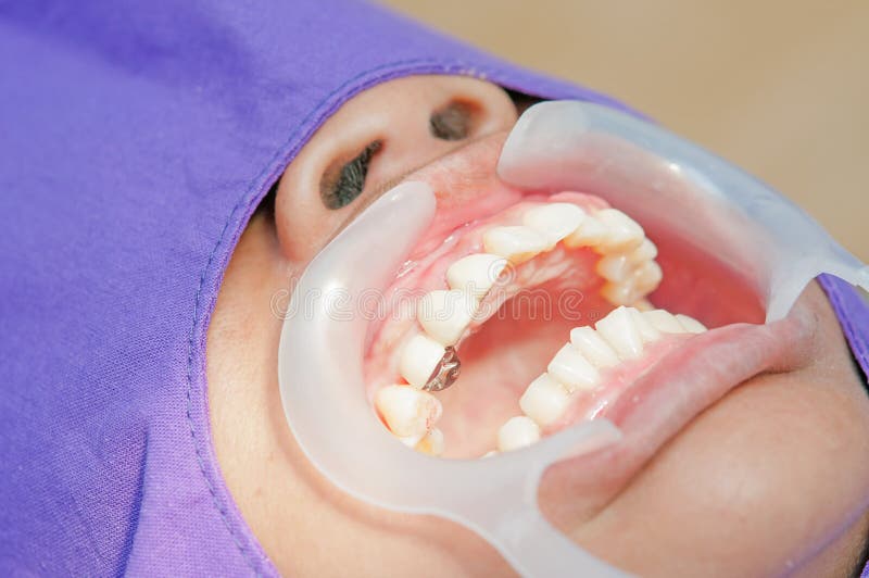 Un dentiste/technicien dentaire plaçant le dentier partiel fixe image stock Un dentiste/technicien dentaire plaçant le dentier partiel fixe image stock