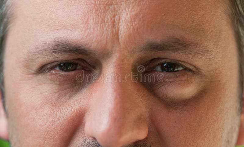 Un ojo con conjuntivitis fotos de archivo Un ojo con conjuntivitis fotos de archivo