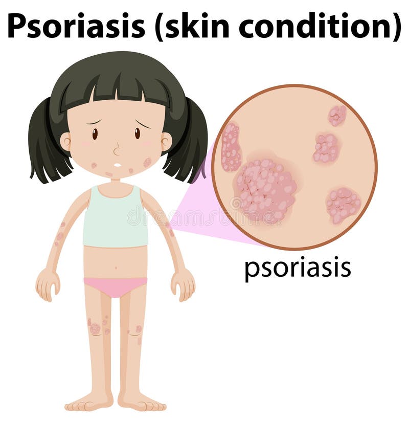 Un psoriasis de Havimg de la muchacha en piel stock de ilustración Un psoriasis de Havimg de la muchacha en piel stock de ilustración