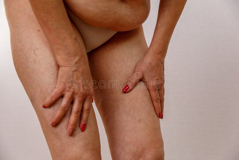 Una donna anziana in mutandine bianche sta toccando le sue gambe con le celluliti e le vene varicose su un fondo isolato leggero fotografia stock libera da diritti Una donna anziana in mutandine bianche sta toccando le sue gambe con le celluliti e le vene varicose su un fondo isolato leggero fotografia stock libera da diritti