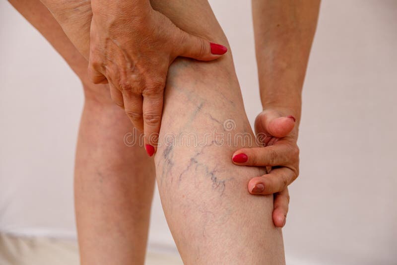 Una donna anziana in mutandine bianche sta toccando le sue gambe con le celluliti e le vene varicose su un fondo isolato leggero