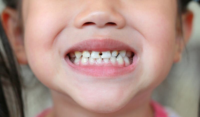 Una ragazzina ravvicinata con i denti rotti e marci