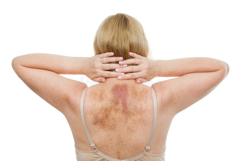 Une contusion sur le dos, une femme avec l'hématome étendu après un massage photo libre de droits Une contusion sur le dos, une femme avec l'hématome étendu après un massage photo libre de droits