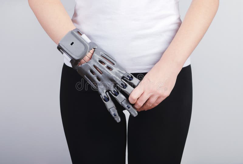 A girl with a prosthesis holds the fingers of the prosthesis with her hand. A girl with a prosthesis holds the fingers of the prosthesis with her hand